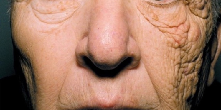 Stokoderm UV30 защита от фотостарения кожи