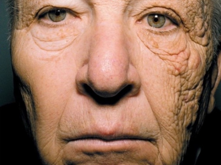 Stokoderm UV30 защита от фотостарения кожи